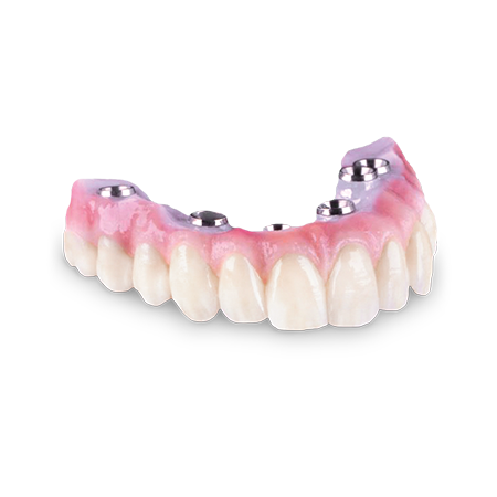 Screw Retained Arch